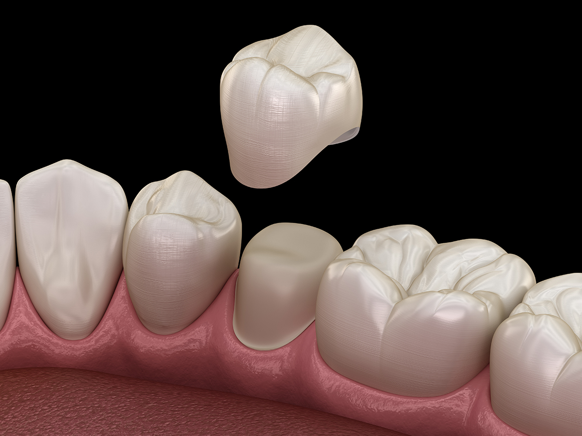 DENTAL CROWNS IN TURKEY