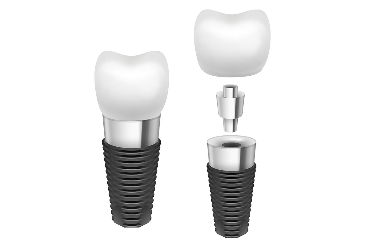 DENTAL IMPLANTS IN TURKEY