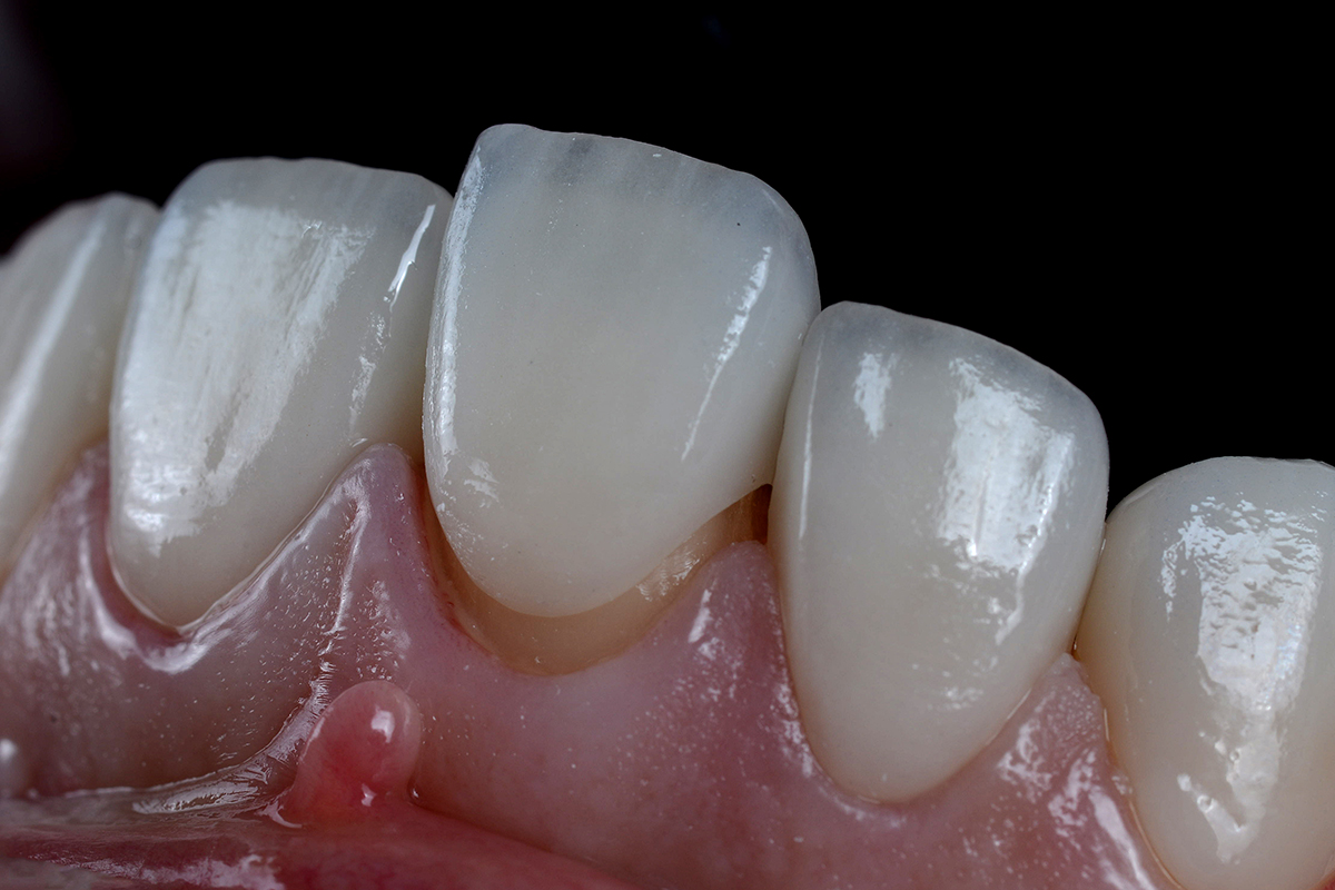DENTAL VENEERS IN TURKEY