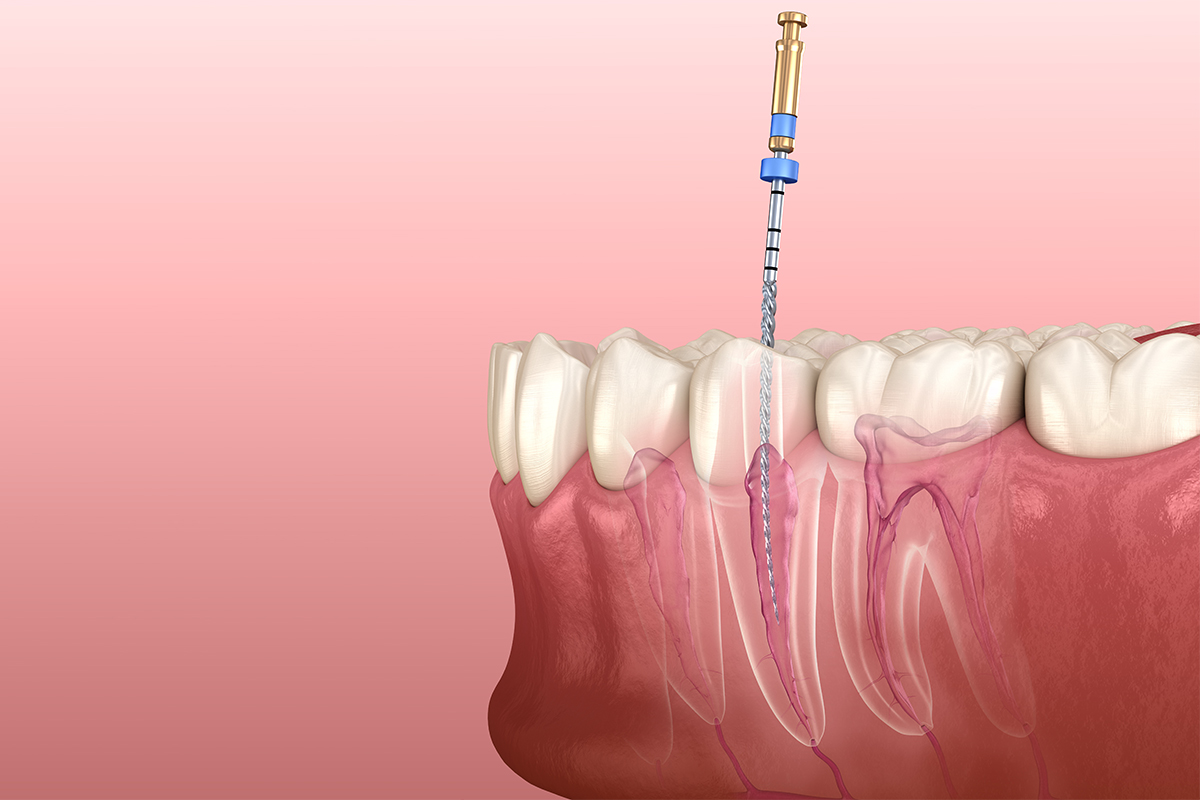 ROOT CANAL TREATMENTS (ENDODONTICS)
